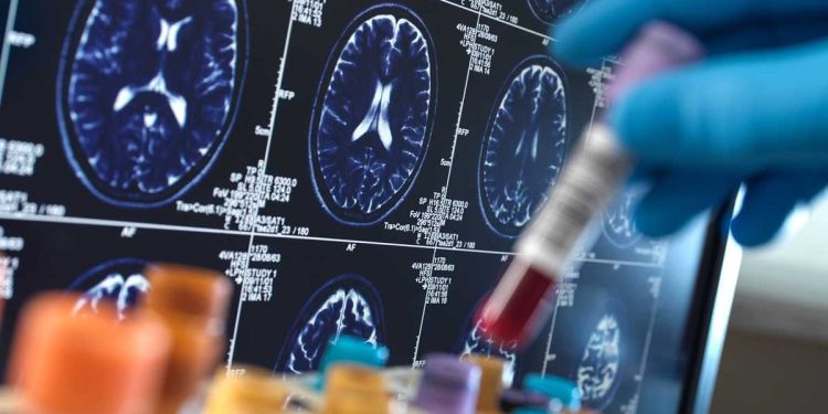 DESCUBREN LA PRIMERA TRANSMISIÓN ACCIDENTAL DEL ALZHÉIMER