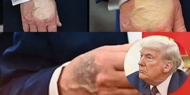 Trump muestra las mismas lesiones que la reina Isabel antes de morir