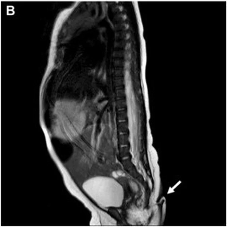 Esta anomalía congénita se ha descrito con mayor frecuencia en varones. (Foto: Journal of Pediatric Surgery Case Reports)