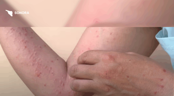 Confirman el primer caso de sarampión en Nogales, Sonora