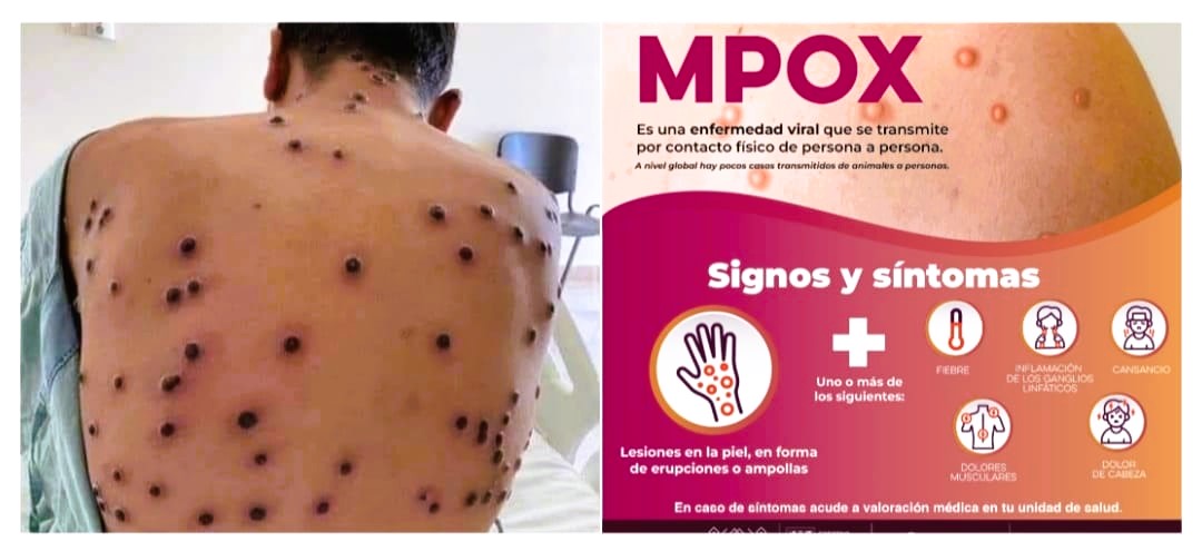 Descarta Salud Sonora&nbsp;casos&nbsp;positivos de viruela símica en la entidad