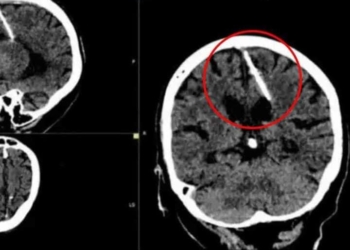 ABUELITA DESCUBRIÓ QUE LLEVABA UNA AGUJA EN EL CEREBRO DESDE HACE 80 AÑOS