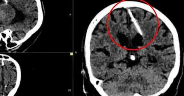ABUELITA DESCUBRIÓ QUE LLEVABA UNA AGUJA EN EL CEREBRO DESDE HACE 80 AÑOS
