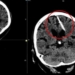 ABUELITA DESCUBRIÓ QUE LLEVABA UNA AGUJA EN EL CEREBRO DESDE HACE 80 AÑOS