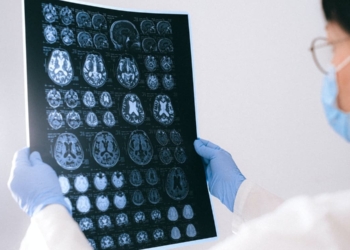 ALZHEIMER PUEDE TRANSMITIRSE POR ACCIDENTES MÉDICOS, ADVIERTE ESTUDIO