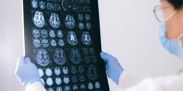 ALZHEIMER PUEDE TRANSMITIRSE POR ACCIDENTES MÉDICOS, ADVIERTE ESTUDIO