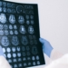 ALZHEIMER PUEDE TRANSMITIRSE POR ACCIDENTES MÉDICOS, ADVIERTE ESTUDIO