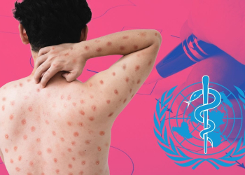 OMS LANZA PLAN ESTRATÉGICO DE PREPARACIÓN Y RESPUESTA CONTRA EL MPOX