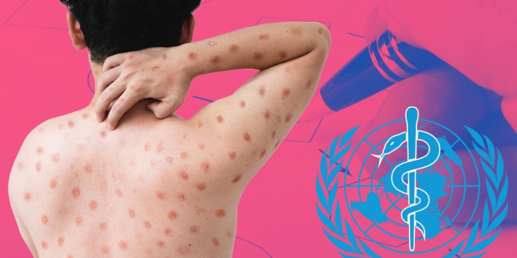 OMS LANZA PLAN ESTRATÉGICO DE PREPARACIÓN Y RESPUESTA CONTRA EL MPOX