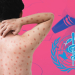 OMS LANZA PLAN ESTRATÉGICO DE PREPARACIÓN Y RESPUESTA CONTRA EL MPOX