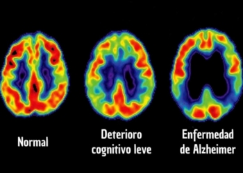 DAN A CONOCER UNA FORMA DE DETECTAR ALZHEIMER EN FASES TEMPRANAS