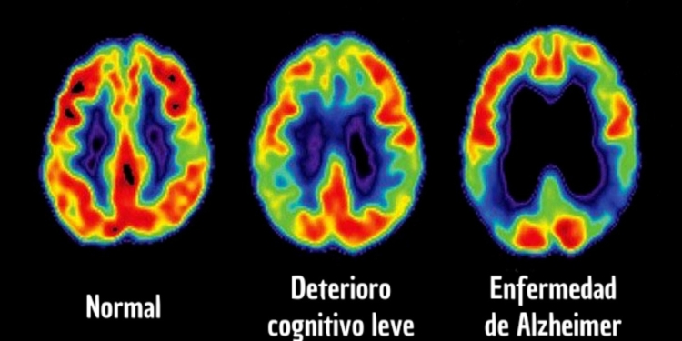 DAN A CONOCER UNA FORMA DE DETECTAR ALZHEIMER EN FASES TEMPRANAS