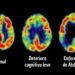DAN A CONOCER UNA FORMA DE DETECTAR ALZHEIMER EN FASES TEMPRANAS