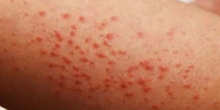 MÉXICO REBASA LOS CUATRO MIL CASOS DE SARAMPIÓN