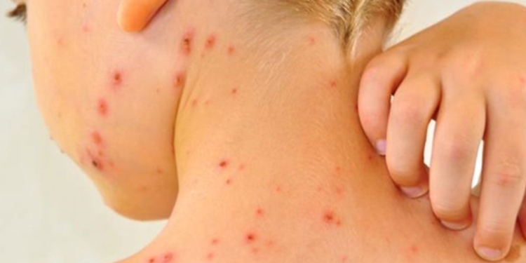 MÉXICO REBASA LOS CINCO MIL CASOS DE SARAMPIÓN