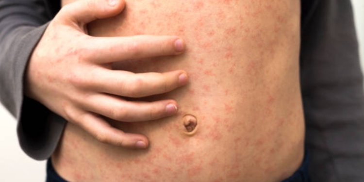 IMPORTACIÓN DE SARAMPIÓN REACTIVA BROTES: OPS PIDE A MÉXICO ALCANZAR COBERTURA DEL 95% DE VACUNACIÓN