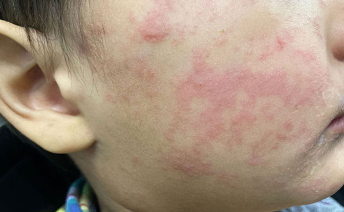 SARAMPIÓN SUPERA LOS 2 MIL CASOS EN LO QUE VA DE 2026