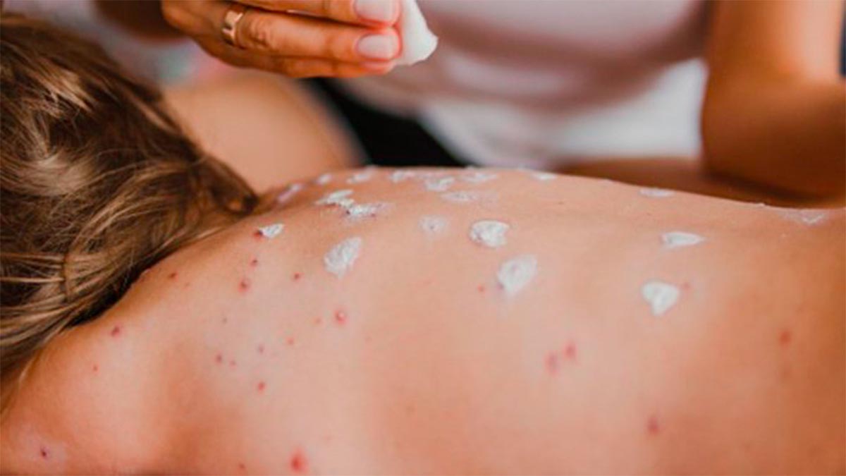 MÉXICO SUMA CASI 14 MIL CASOS DE SARAMPIÓN; ¿CUÁL ES EL ESTADO CON MÁS CONTAGIOS?